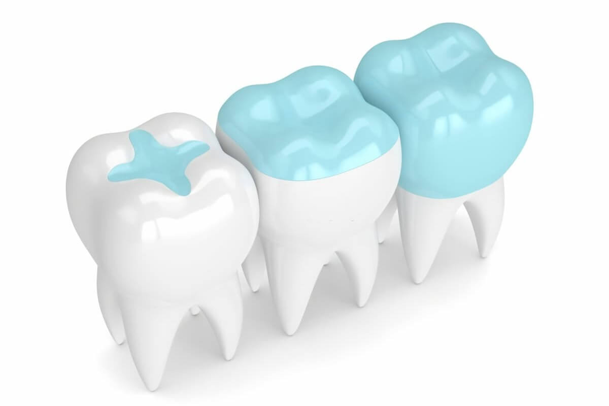 tipos composite dental